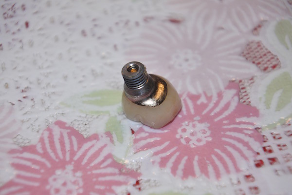 インプラントの歯が折れてしまった インプラントの歯が折れてしまった